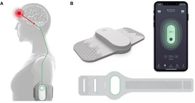 Remote electrical neuromodulation (REN) wearable device for adolescents with migraine: a real-world study of high-frequency abortive treatment suggests preventive effects